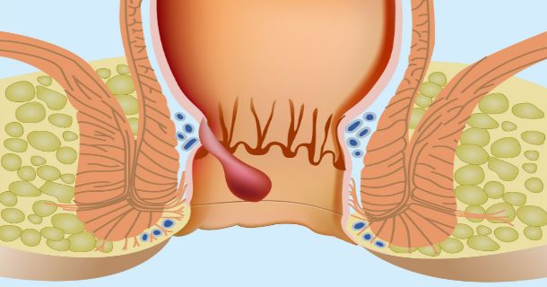 هموروئید داخلی