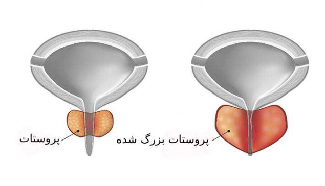 درمان های جراحی بزرگی پروستات