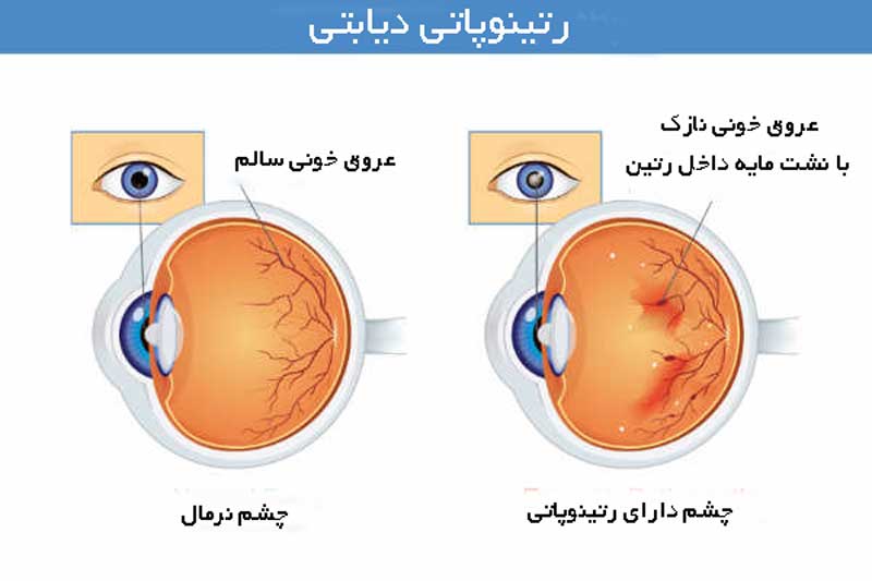  رتینوپاتی دیابتی