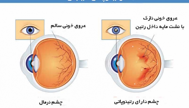  رتینوپاتی دیابتی