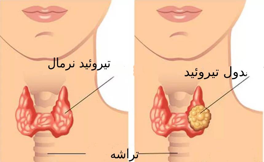 تشخیص سرطان تیروئید