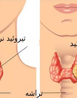 تشخیص سرطان تیروئید