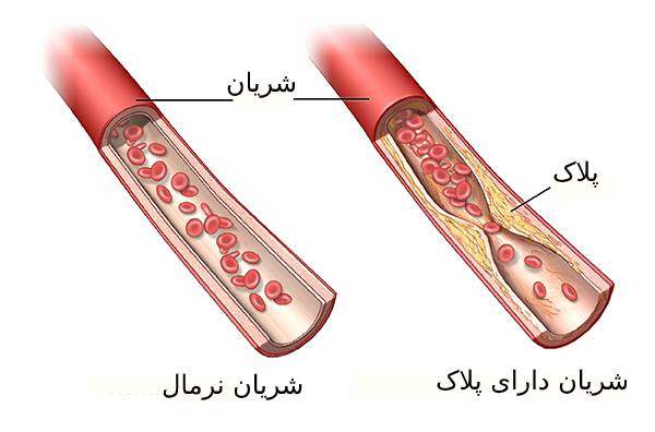 ضخیم شدن شریان و رگها