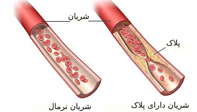 ضخیم شدن شریان و رگها