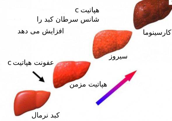 تفاوت سیروز با هپاتیت