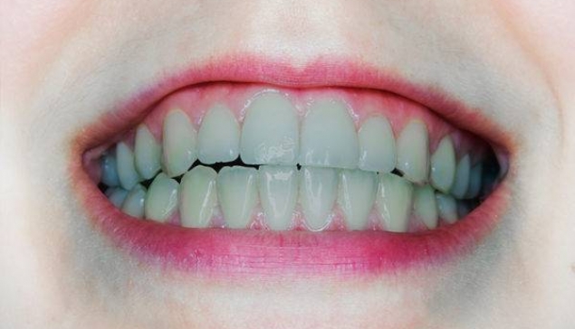 دندانهای خاکستری