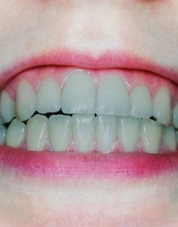 دندانهای خاکستری
