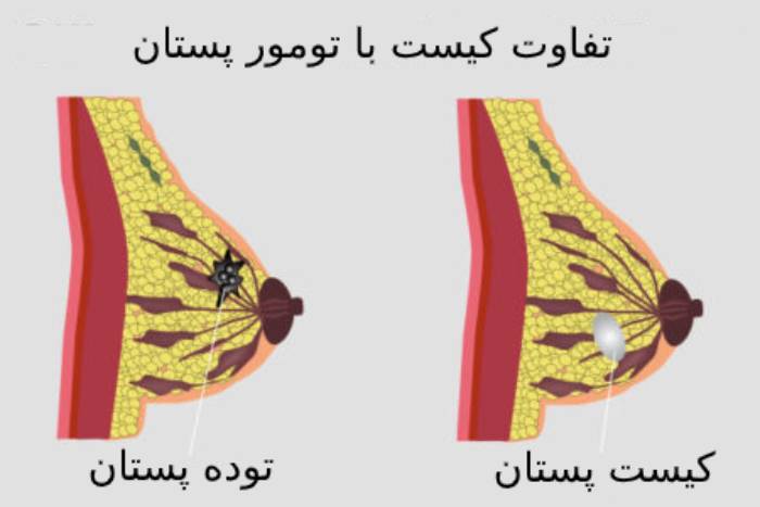 کیست پستان