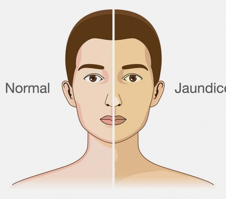 زردی چیست؟ علائم، علل، تشخیص، درمان و پیشگیری