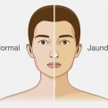 زردی چیست؟ علائم، علل، تشخیص، درمان و پیشگیری