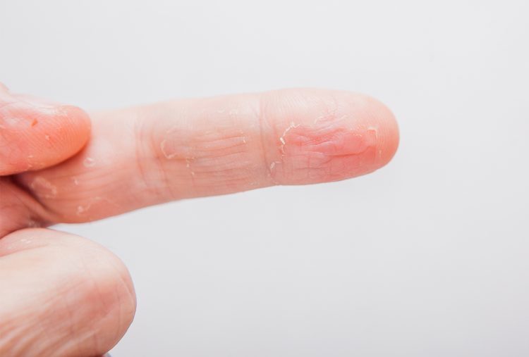 درمان پوسته پوسته شدن نوک انگشتان