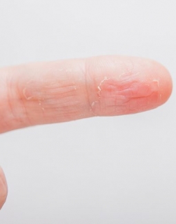 درمان پوسته پوسته شدن نوک انگشتان