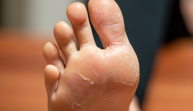 درمان خانگی برای پوسته پوسته شدن پا
