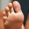 درمان های خانگی برای پوسته پوسته شدن پا