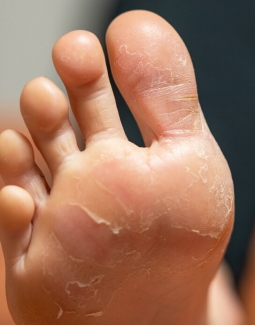 درمان خانگی برای پوسته پوسته شدن پا