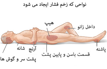 محل هایی که زخم فشار ایجاد می شود