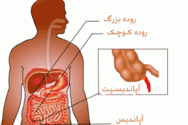 آپاندیسیت چیست