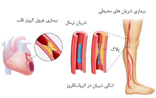 گرفتگی شریان