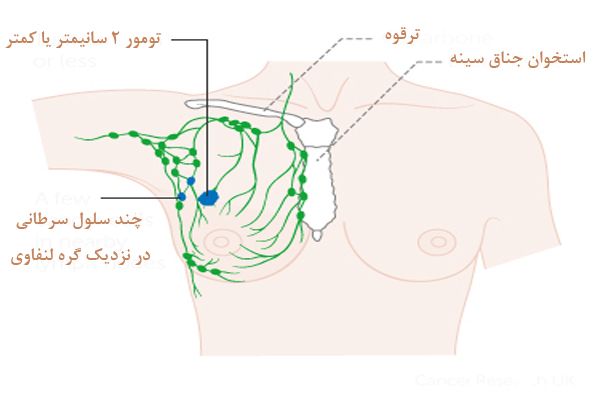 تومور زیر بغل