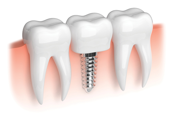 ایمپلنت دندان