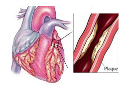 گرفتگی عروق قلب